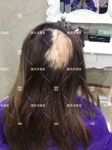 西寧織發(fā)補(bǔ)發(fā)需要多少錢,哪家補(bǔ)發(fā)技術(shù)好？