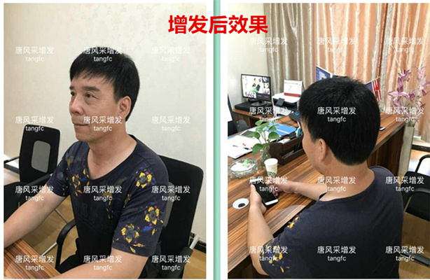 如何生發(fā)密發(fā)?到底有沒有生發(fā)奇效的藥物呢？