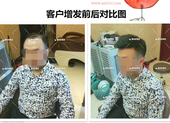 防偷防盜防不了發(fā)際線, 變禿頂了怎么辦？
