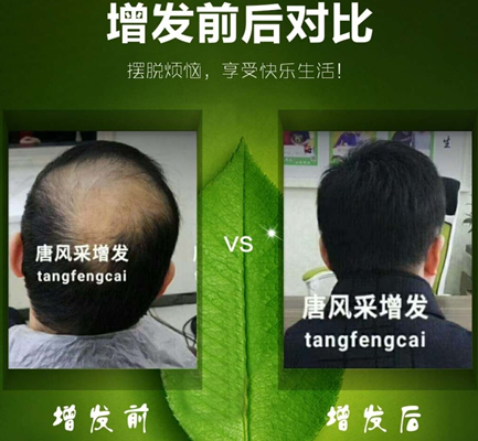 脫發(fā)嚴重咋辦？