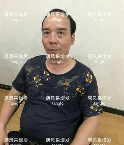 朋友碰面不敢認(rèn)，直擊發(fā)友增發(fā)后的真實(shí)改變！