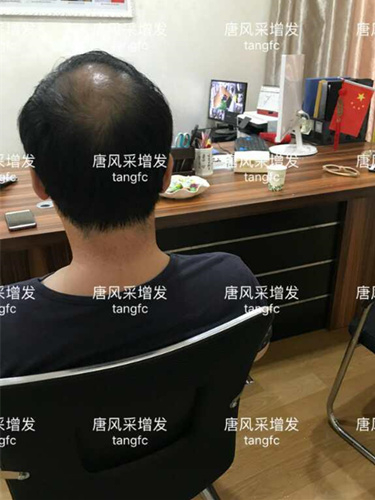 朋友碰面不敢認(rèn)，直擊發(fā)友增發(fā)后的真實(shí)改變！