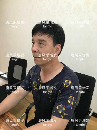 朋友碰面不敢認(rèn)，直擊發(fā)友增發(fā)后的真實(shí)改變！