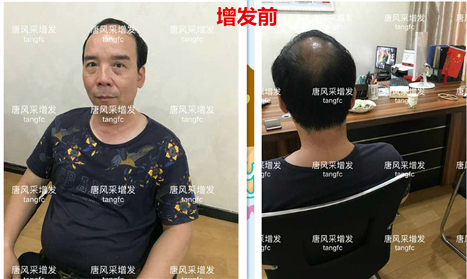 朋友碰面不敢認(rèn)，直擊發(fā)友增發(fā)后的真實(shí)改變！