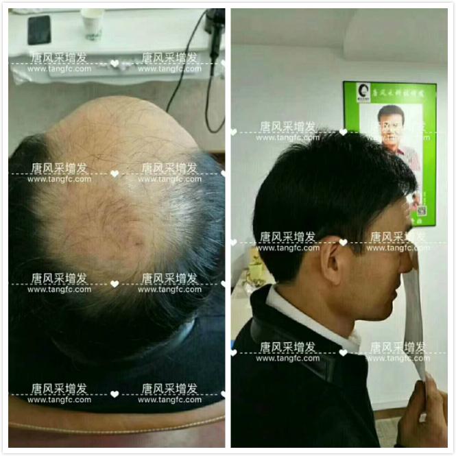 臺(tái)州哪里買假發(fā)好，頭發(fā)稀疏適合什么樣的假發(fā)？
