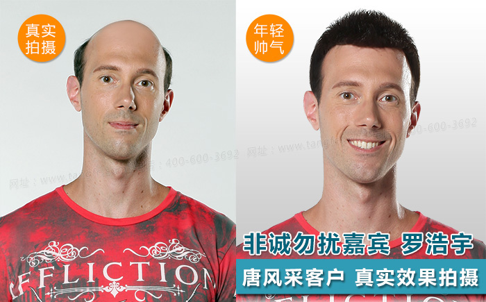 臺(tái)州哪里買假發(fā)好，頭發(fā)稀疏適合什么樣的假發(fā)？