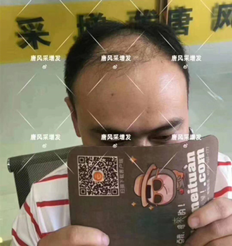 西寧織發(fā)補發(fā)哪家好，真的能改變我的脫發(fā)形象嗎？ 
