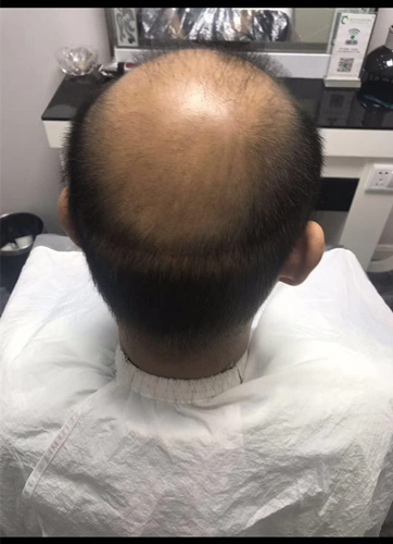 西寧織發(fā)補發(fā)哪家好，真的能改變我的脫發(fā)形象嗎？ 
