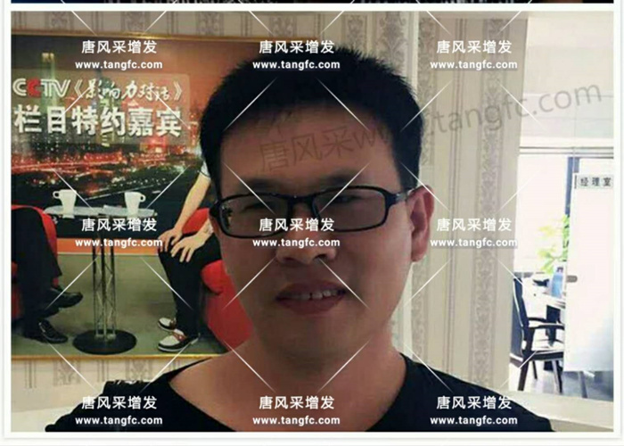 老師，我要你“脫”掉禿頂！