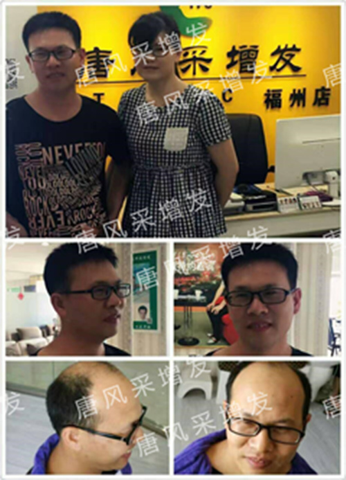 老師，我要你“脫”掉禿頂！