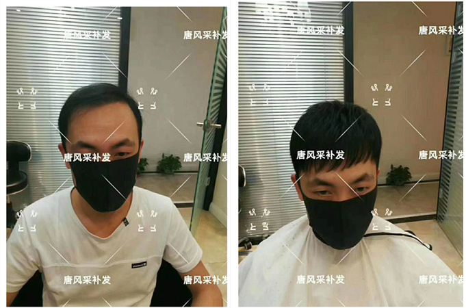 男士禿頂了 唐風采客戶案例