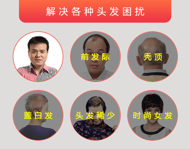 綠茶能治療脫發(fā)嗎？