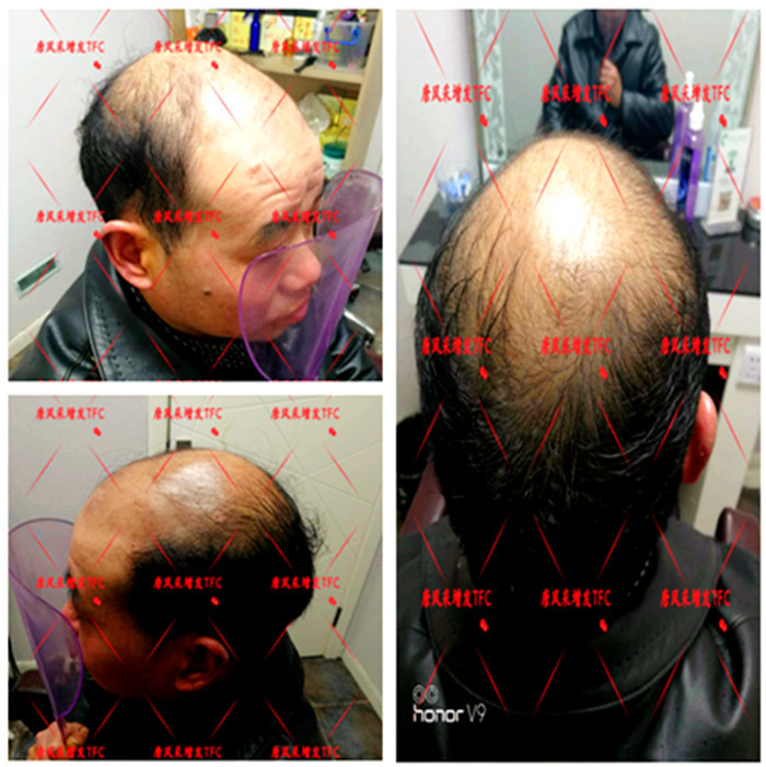 真人頭發(fā)假發(fā)套 唐風采隱形增發(fā)客戶案例
