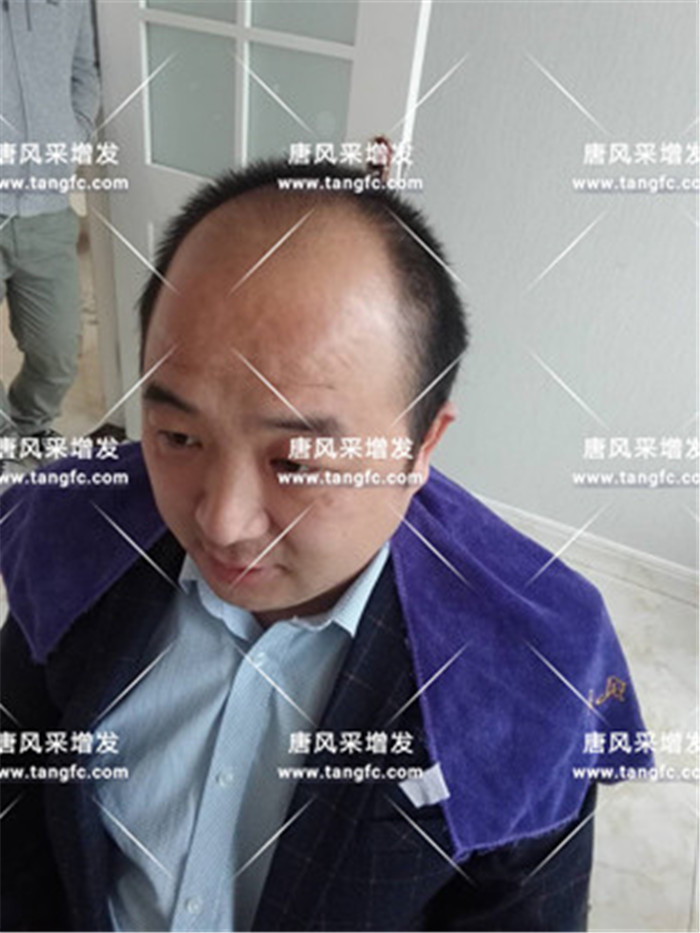 仿真頭皮假發(fā) 80后的小吳客戶案例