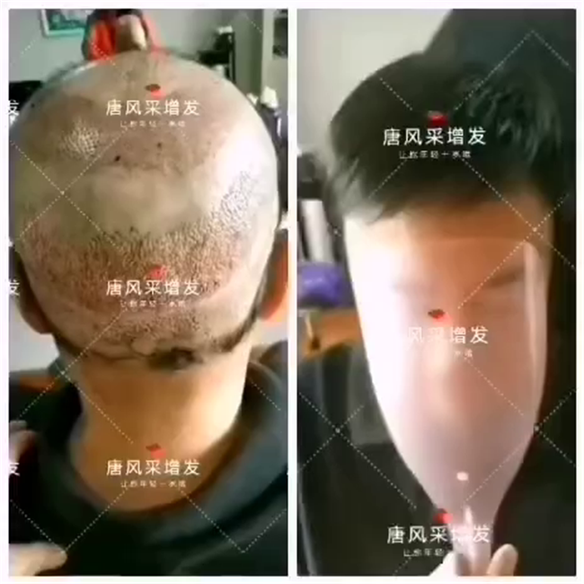 仿真頭皮假發(fā)價格 唐風(fēng)采客戶王先生增發(fā)后