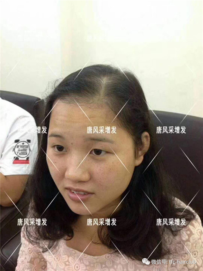 無(wú)痕補(bǔ)發(fā)看得出是假發(fā)嗎 唐風(fēng)采客戶增發(fā)前