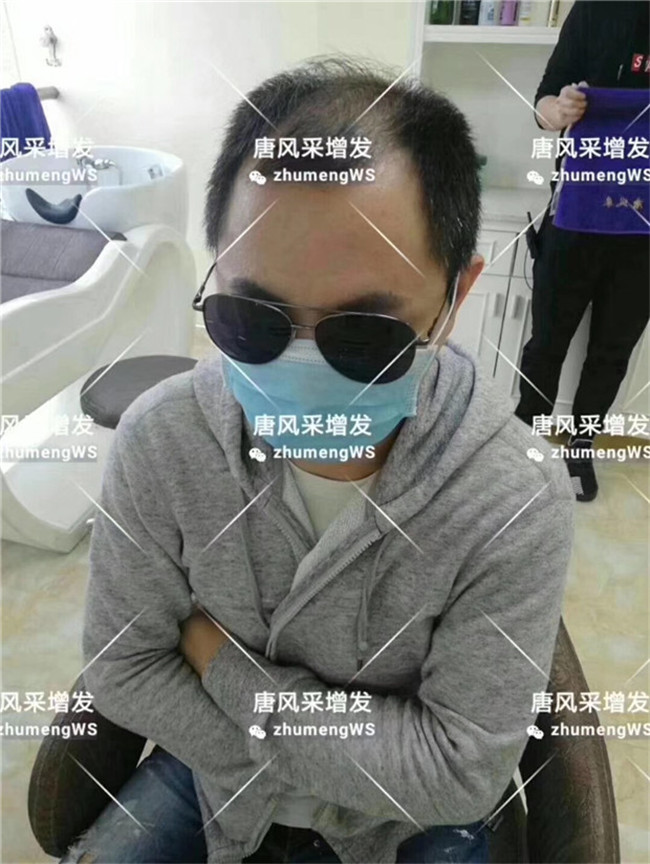 頭頂粘貼假發(fā)片哪里買 唐風采客戶章先生增發(fā)前