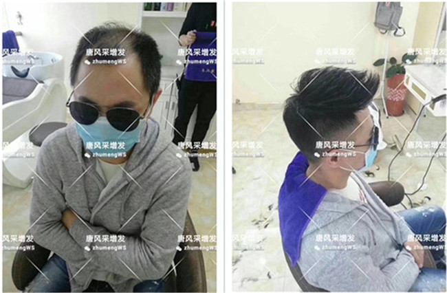 頭頂粘貼假發(fā)片 唐風采客戶章先生增發(fā)后