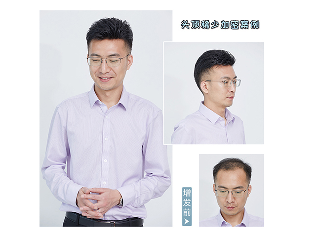 隱形增發(fā)對比照 \