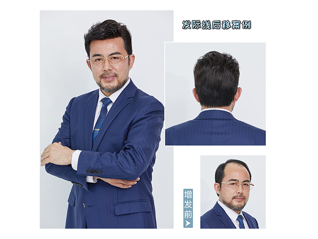 隱形增發(fā)對比照 \