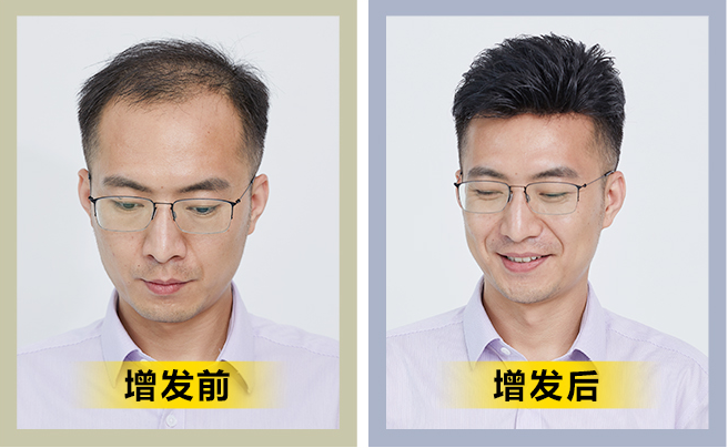 織發(fā)補(bǔ)發(fā)的優(yōu)勢(shì) \