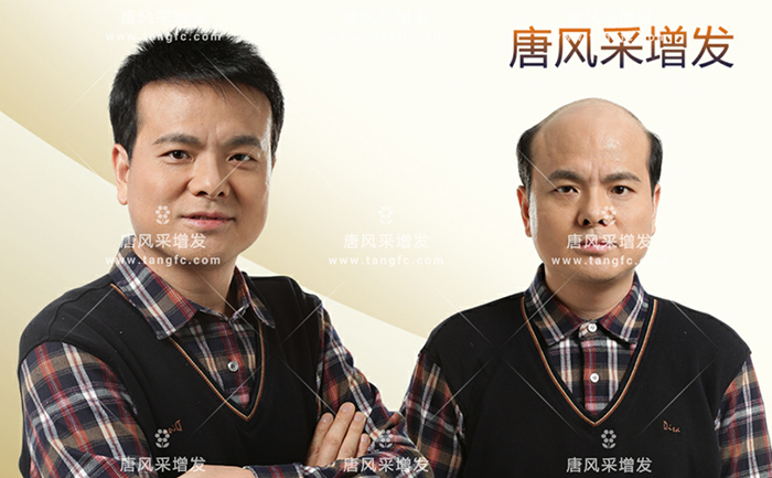 男士隱形補(bǔ)發(fā) \