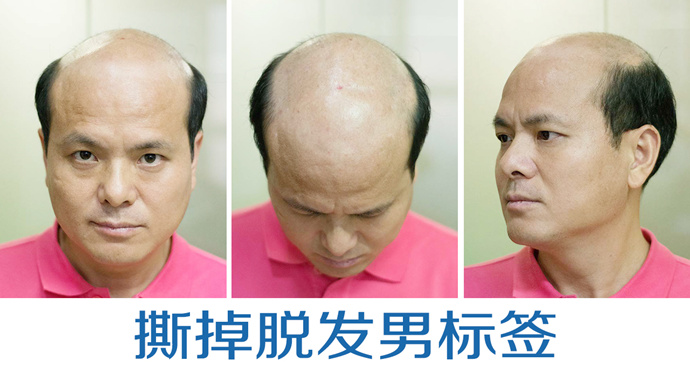 男士隱形補(bǔ)發(fā) \