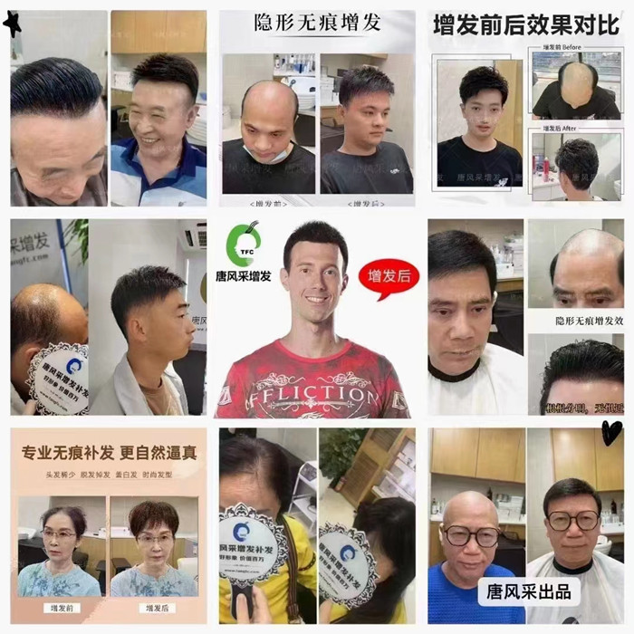 脫發(fā)做補(bǔ)發(fā)多少錢 \