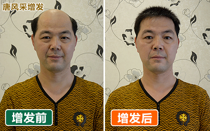 北京買隱形假發(fā)哪家好？效果好性價比高就選它