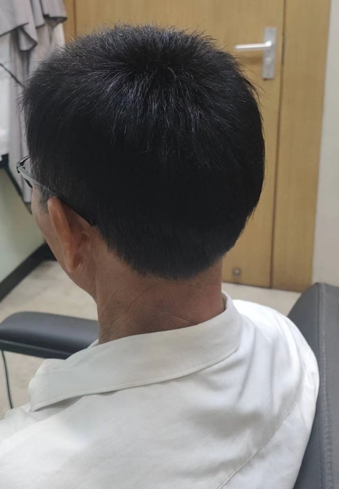 稀疏頭發(fā) \
